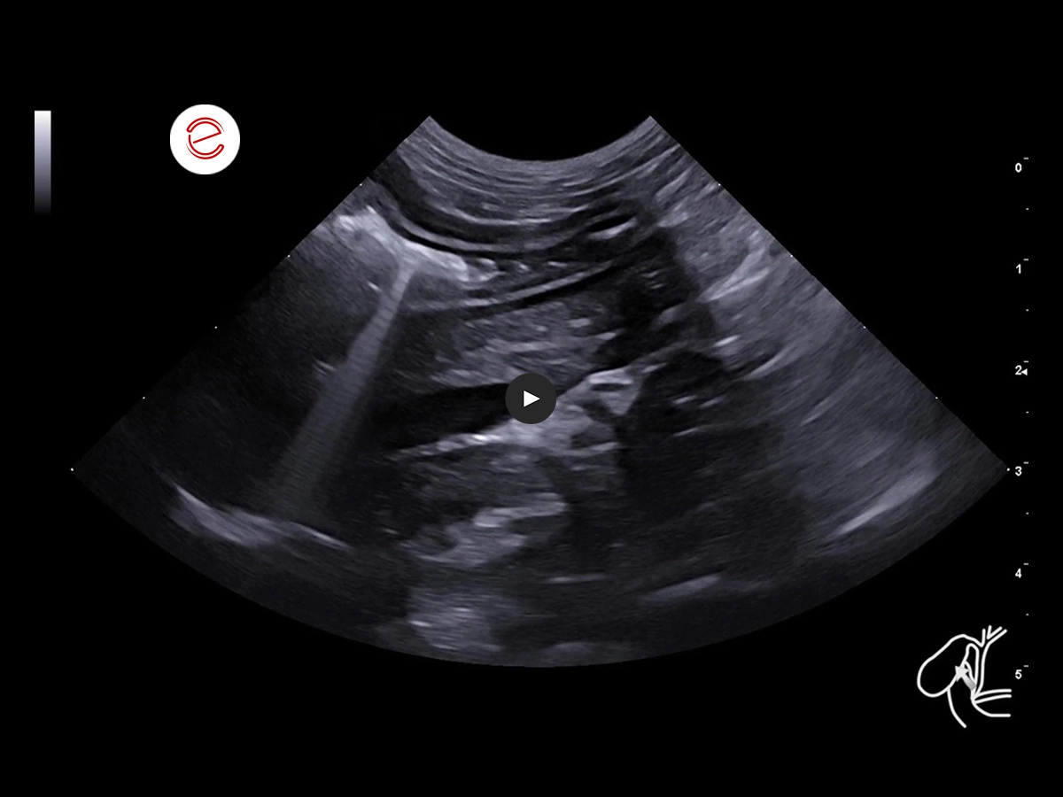 Right longitudinal retrocostal scan.