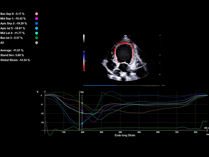 MyLab™FOX - Dog - left ventricle wall motion study XStrain