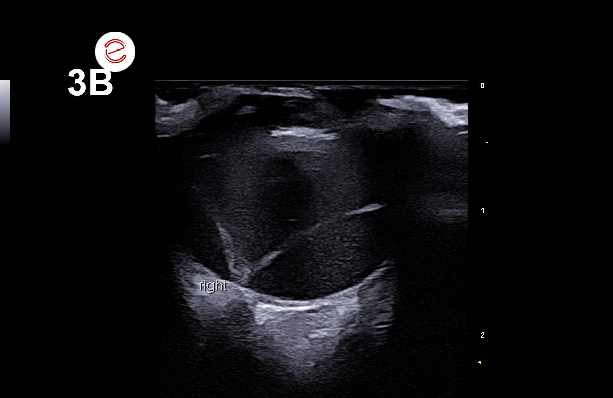 Figure 3B: The ultrasonography shows a thin, hyperechoic, curvilinear structure in the vitreous chamber, resembling a V-shaped echo (green arrow). There is subretinal hemorrhage, which is seen as a homogenous hypoechoic area (white arrow).