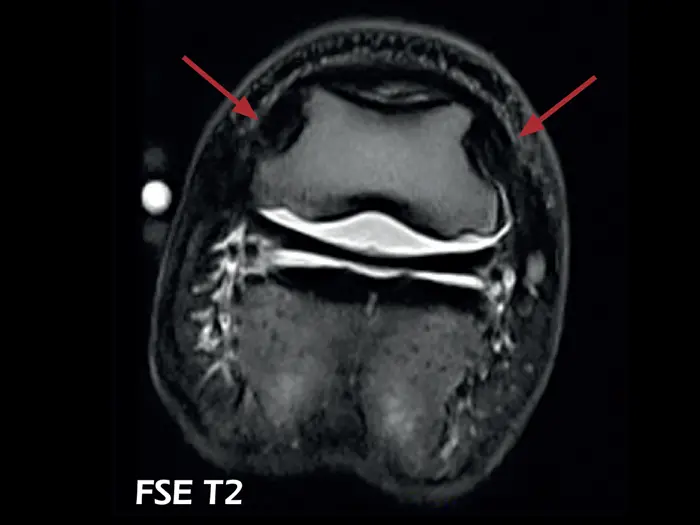 O-scan VET - Lesion of the collateral ligaments of the coffin joint 02