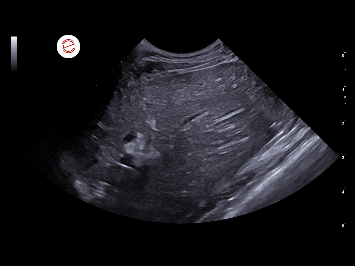 Left transverse intercostal scan.