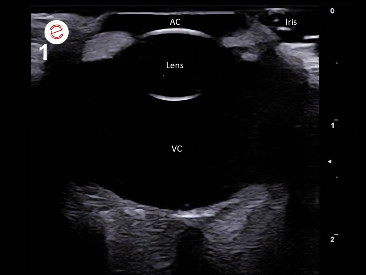Figure 1. An ultrasonography image of a normal ocular globe showing that the anterior chamber (AC), and the lens and vitreous chamber (VC) appear anechoic. The iris shows a hyperechoic band-like structure.