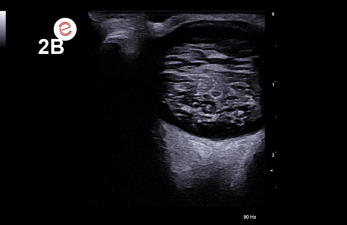 Figure 2B: The ultrasonography image shows ocular abnormalities and shrunken globe with extensive calcification and loss of the normal eye shape.