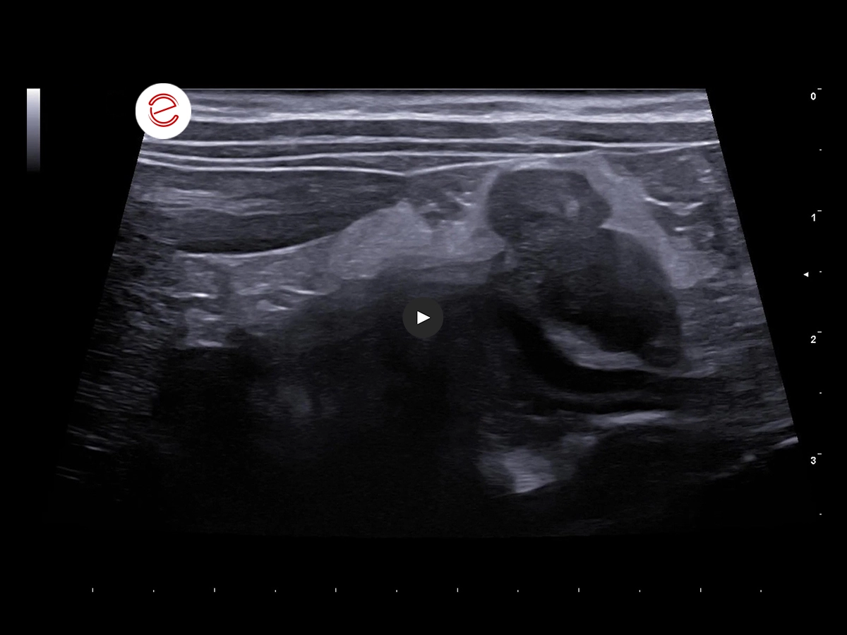 Longitudinal right retrocostal scan.