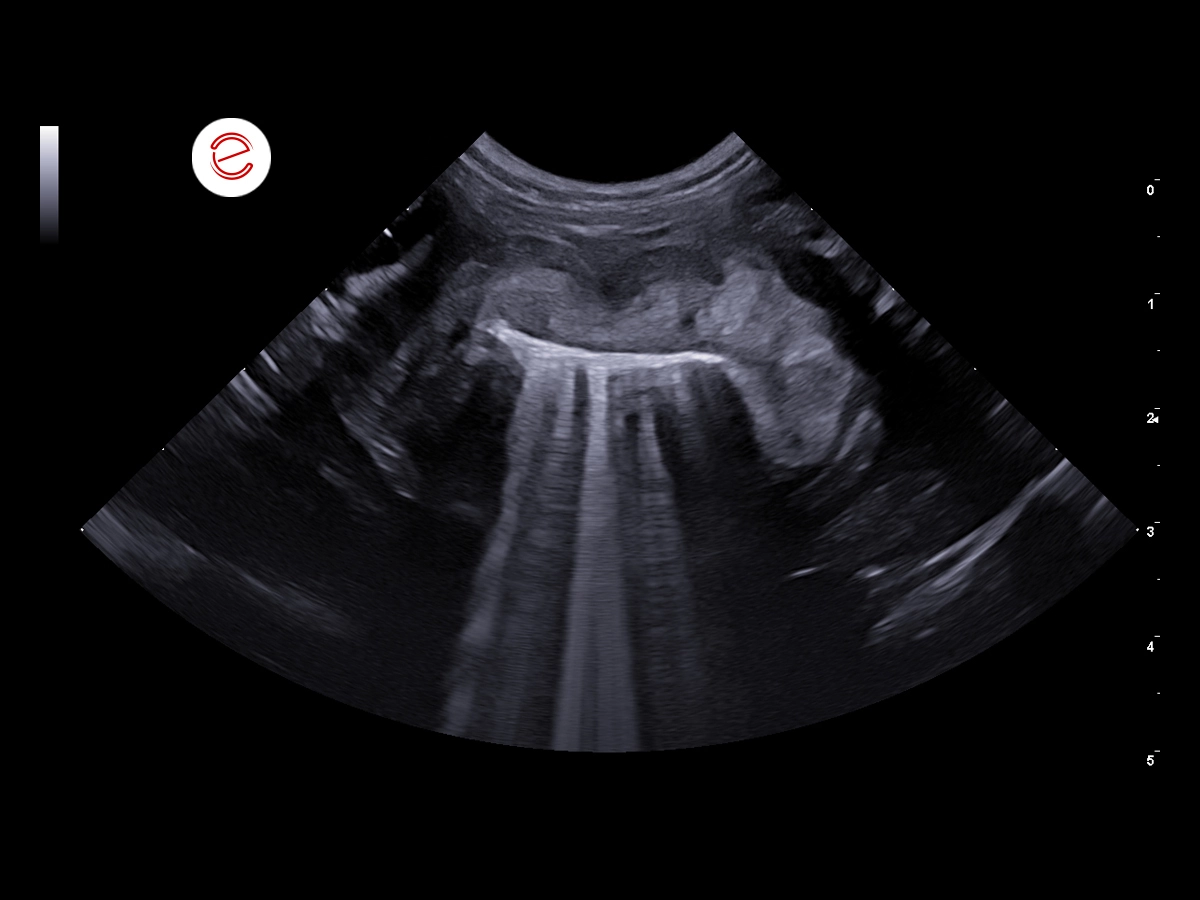 Right transverse retrocostal scan.