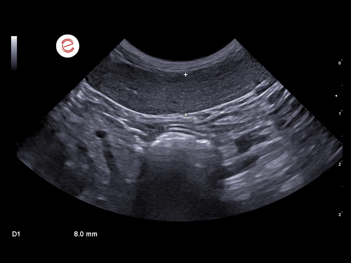 Left longitudinal retrocostal scan.