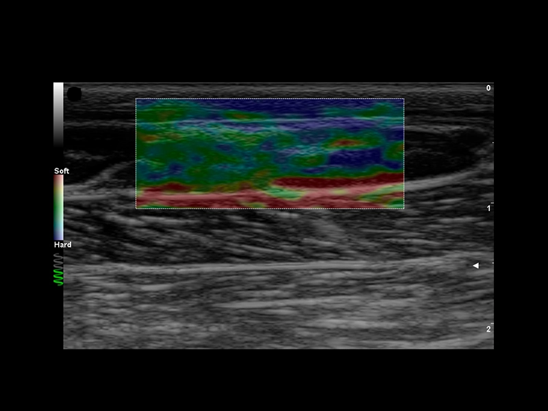 Equine clinical image - tendon stiffness with ElaXto