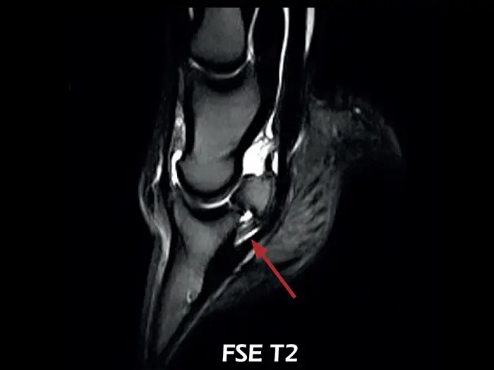 O-scan VET - Lesion of the collateral ligaments of the coffin joint 04